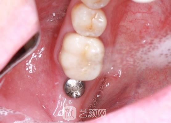 福州登特口腔医院种植牙多少钱？全新收费标准及实例出炉