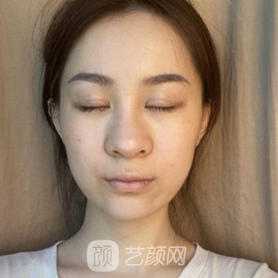 长沙美莱刘欢做鼻子怎么样？全新实例曝光