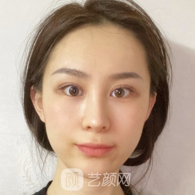 长沙美莱刘欢做鼻子怎么样？全新实例曝光