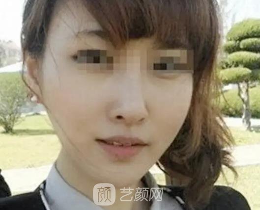 南京连天美美容医院面部吸脂实例公布｜前后对比让人惊讶