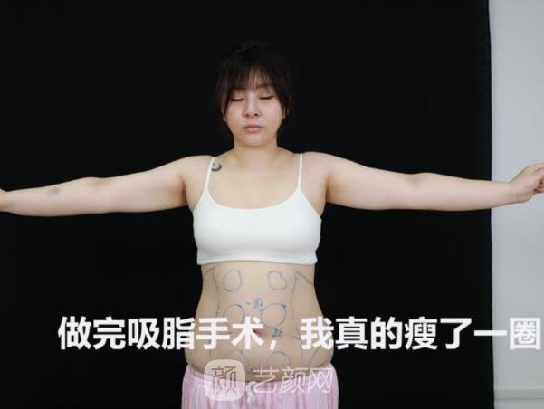 北京润美玉之光张红芳吸脂靠谱吗？全新医生实力及实例分享