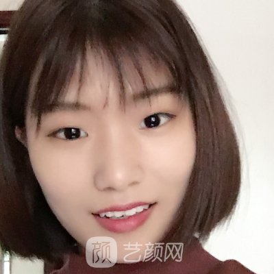 海口美咖医疗美容医院双眼皮做的怎么样？医院招牌实例出炉