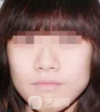 北京伊美尔美白针收费价格贵吗？医生简介+实例更新
