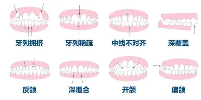 牙齿矫正hg05.jpg