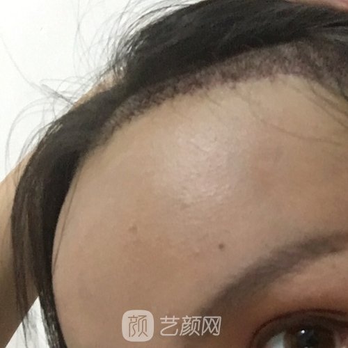 郑州集美美容医院头发种植实例分享｜成果自然无痕