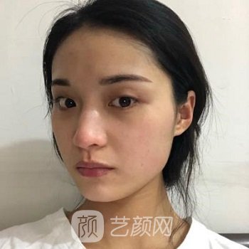 上海华美医疗美容医院是正规医院吗？怎么样？眼修复实例