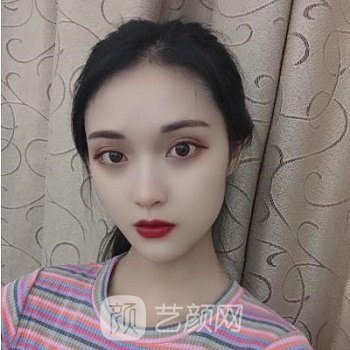 上海华美医疗美容医院是正规医院吗？怎么样？眼修复实例