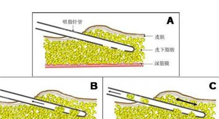 冷冻溶脂有什么好处