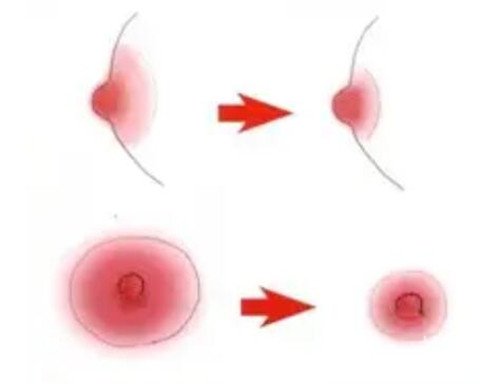 乳晕缩小手术成果如何？成果能维持多久？