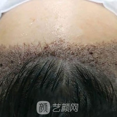 昆明新生植头发怎么样？医院实力及实例出炉