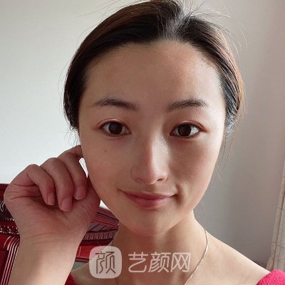 昆明美诚均美整形医院靠谱吗？全新双眼皮实例公布