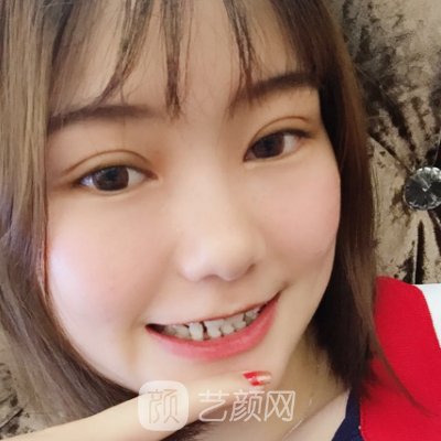 天津美莱口腔医院牙齿正畸怎么样？矫正前后成果图曝光