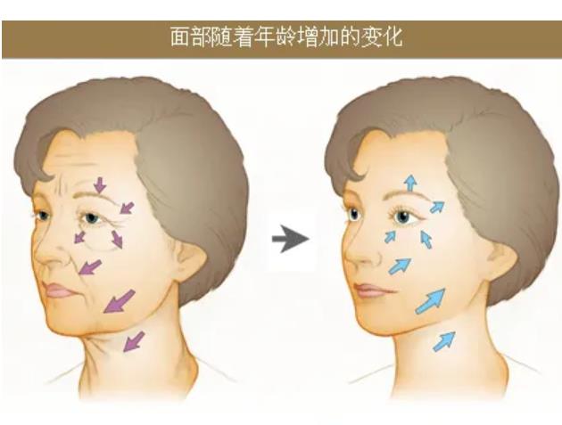 悬吊提升除皱手术的5大优势