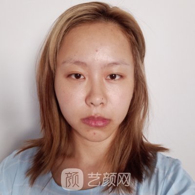 重庆唐婷医生双眼皮实例公开|90天修复细节分享