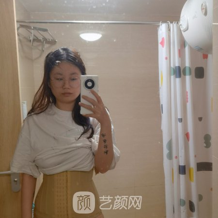 重庆天艺美徐志强吸脂怎么样？医生实力及实例出炉