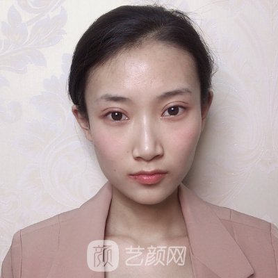 重庆赛格尔整形美容医院正规吗？2022招牌双眼皮实例曝光