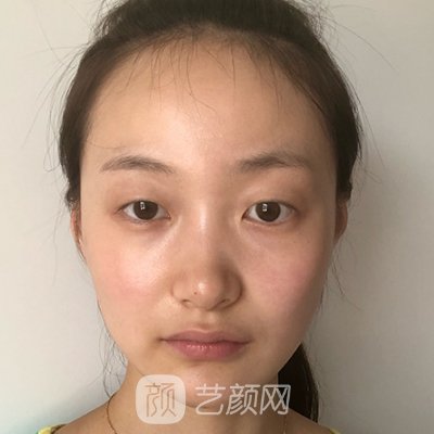 重庆佳美医疗美容诊所双眼皮实例出炉|附亲身体验成果图