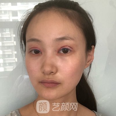 重庆佳美医疗美容诊所双眼皮实例出炉|附亲身体验成果图