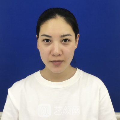 西安晗美整形医院脂肪填充做的怎么样？医院全新招牌实例出炉