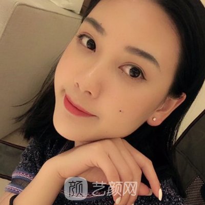 西安晗美整形医院脂肪填充做的怎么样？医院全新招牌实例出炉