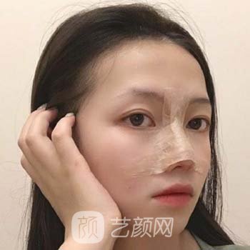 谢红权医生鼻子实例，耳软骨隆鼻前后对比照片展示