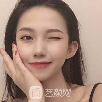 谢红权医生鼻子实例，耳软骨隆鼻前后对比照片展示