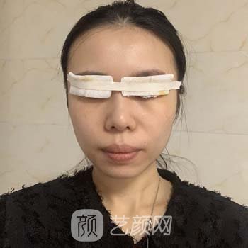 成都杨迪双眼皮实例，微创技术打造无痕美眼