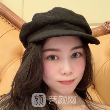 成都杨迪双眼皮实例，微创技术打造无痕美眼