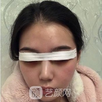 华西医院李正勇双眼皮实例结果展示，人生仿佛已经开挂
