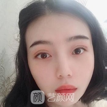 华西医院李正勇双眼皮实例结果展示，人生仿佛已经开挂