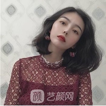 华西医院李正勇双眼皮实例结果展示，人生仿佛已经开挂