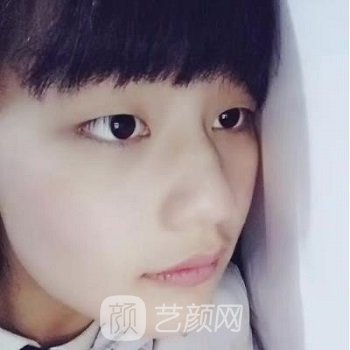 虞冬梅双眼皮修复怎么样？个人简介+术后实例对比图