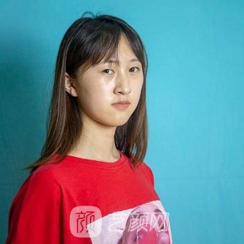 李正勇双眼皮实例，自然无暇的美丽眼眸速成