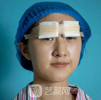 李正勇双眼皮实例，自然无暇的美丽眼眸速成