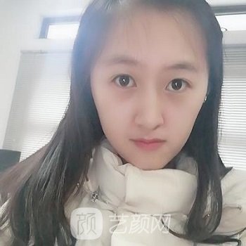 李正勇双眼皮实例，自然无暇的美丽眼眸速成