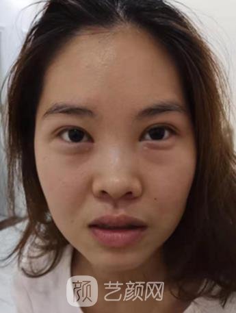 爱美丽邵志明院长做眼袋怎么样？去眼袋实例真人分享