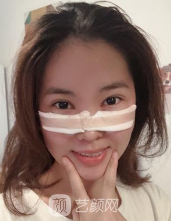 爱美丽邵志明院长做眼袋怎么样？去眼袋实例真人分享