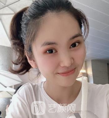 爱美丽邵志明院长做眼袋怎么样？去眼袋实例真人分享
