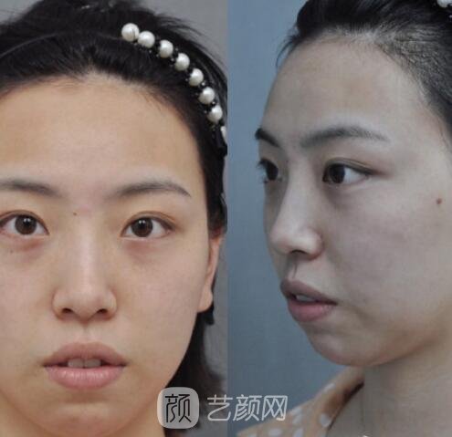 广州南珠整形美容医院电话|怎么样？骨干医生介绍+脂肪填充实例