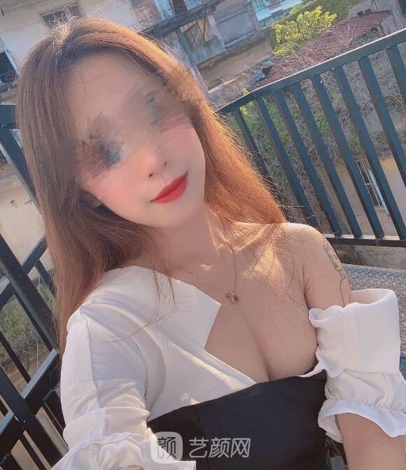 姜宇禄隆胸技术怎么样？详细介绍+假体隆胸实例更新