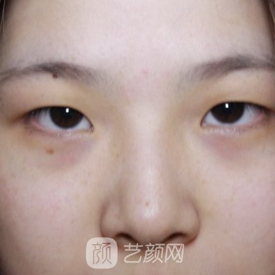 深圳美亚割双眼皮靠谱吗？2022招牌实例展示