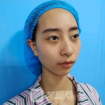 郭英宁做的眼睛怎么样？多少钱？个人介绍+双眼皮手术实例