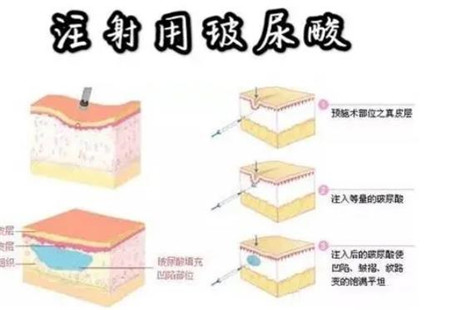 注射玻尿酸有哪些副作用，如何避免危害