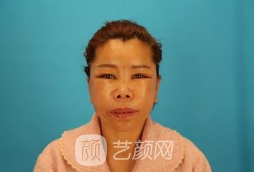 南京康美整形医院何美珍院长做小切口拉皮怎么样？附实例