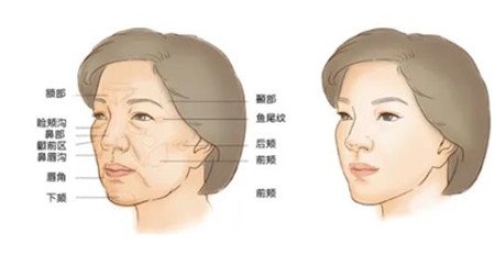 昆明艺星全脸填充怎么样？附价格表和实例