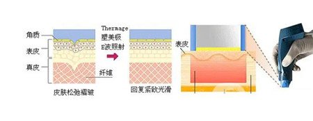 南方医院整形科做热玛吉贵不贵？价格（价目）收费明细公开！附实例赏析