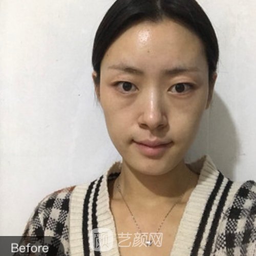 深圳医美汇医疗美容双眼皮正规吗？全新实例出炉
