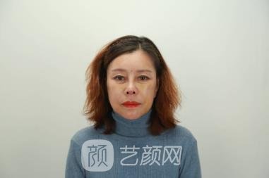 北京八大处张妍拉皮除皱美容实例，医生个人简介修复过程图片