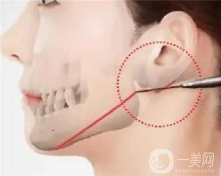 北京口腔医院整形怎么样？供2021价格表及整下颌角实例