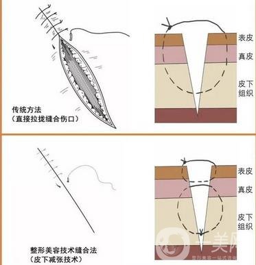郑大二附院整形科去疤痕果咋样？实例果_2021价格表全览！